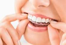 Know Everything About the Invisalign Cost Structure and Pricing Details in Kelowna