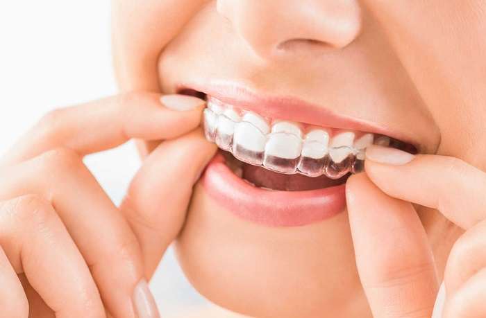 Know Everything About the Invisalign Cost Structure and Pricing Details in Kelowna